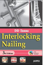 Interlocking nailing