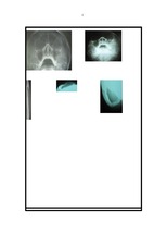 Nhận xét đặc điểm lâm sàng, x-quang và kết quả điều trị gãy xương gò má cung tiếp bằng nẹp vít