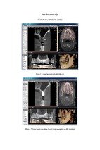 Nghiên cứu điều trị mất răng hàm trên từng phần bằng kỹ thuật implant có ghép xương (pl1)