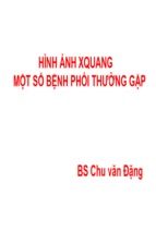 Hình ảnh xquang một số bệnh phổi thường gặp