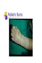 Pediatric burns